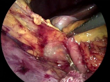 Laparoscopic Right Colectomy - Step III + IV