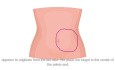 Adnexial Torsion