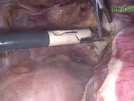 Total Excision of the Uterus by Use of Laparoscopy
