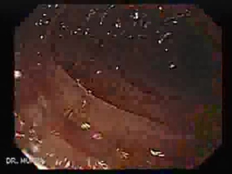 Colon Adenocarcinoma - Metastatic Of The Stomach (2 of 3)