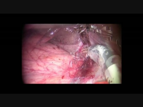 Robot-assisted Laparoscopic Right Hemihepatectomy