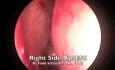 Maxillary Sinus Drainage Under Local Anesthesia