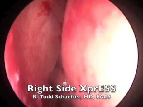 Maxillary Sinus Drainage Under Local Anesthesia