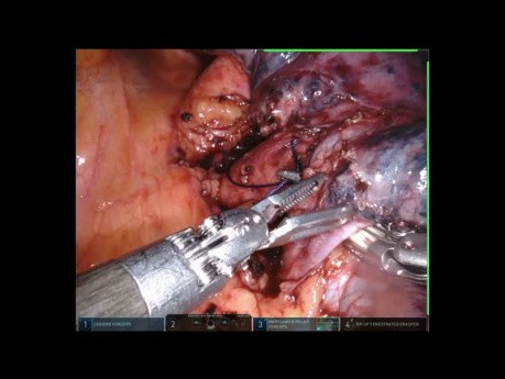 Anatomic Segmentectomy
