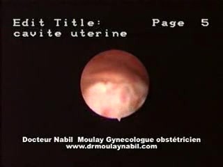 Hysteroscopic Aspect Of Endometrial Cancer