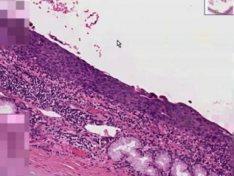 Carcinoma in situ - Histopathology - Lung, bronchus