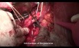 Whipple procedure (pancreatoduodenectomy ) for cancer and complementary indurative pancreatitis