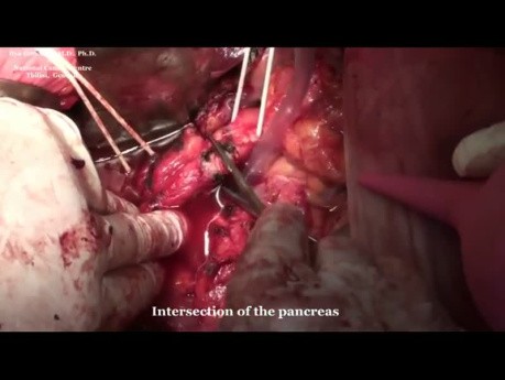 Whipple procedure (pancreatoduodenectomy ) for cancer and complementary indurative pancreatitis