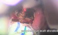 Diverticulotomy - Endoscopy