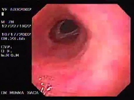 Esophagus Schatzki Ring (3 of 3)