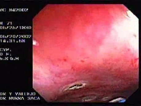 Radiation Proctosigmoiditis (13 of 14)