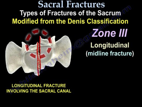 Sacral Fractures Classifications