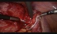 Laparoscopic Management of Ovarian Dermoid Cyst