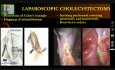 Laparoscopic Cholecystectomy - Operative Surgery
