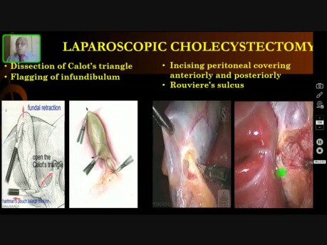 Laparoscopic Cholecystectomy - Operative Surgery