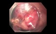 Gastric Hyperplastic Polyp