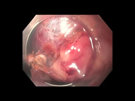 Gastric Hyperplastic Polyp