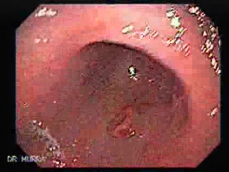 Heterotopic pancreas