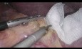 Sleeve Gastrectomy