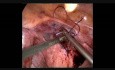 Laparoscopic Pelvic Organ Prolapse Surgery (POPS)