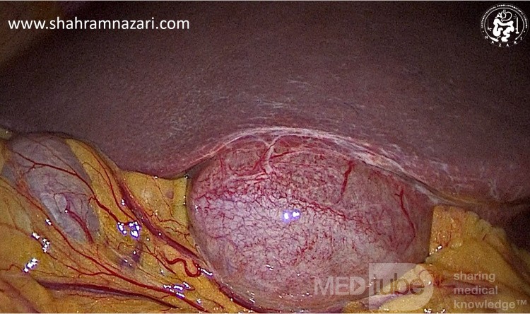 Accessory Liver Tissue on the Gallbladder