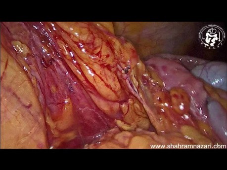 Laparoscopic Extended Right Hemicolectomy - Carcinoma of the Cecum