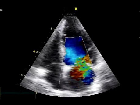 Ruptured Papillary Muscle as a Cause of Acute Mitral Regurgitation