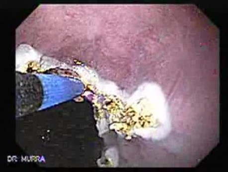 Barrett's Esophagus of long segment - state after APC (8 of 11)