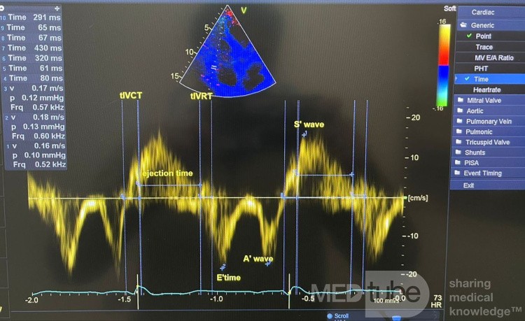 RV Diastolic Function by Tissue Doppler and Tei Index