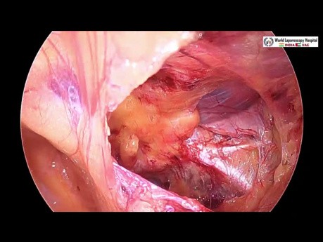 Laparoscopic Bilateral Inguinal Hernia Repair