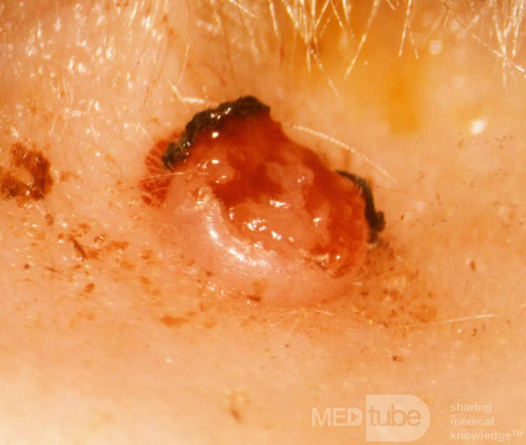 Keratoacanthoma