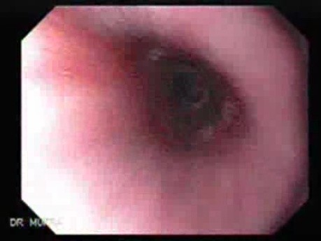 Gastric Cicatrization With Pylorus Stenosis (7 of 23)