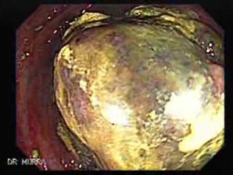 Non - Hodgkin's Lymphoma Of The Cecum (2 of 10)