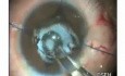 Pupillary Membranes - Fugo Blade Cut