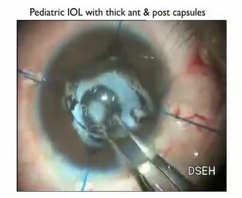 Pupillary Membranes - Fugo Blade Cut