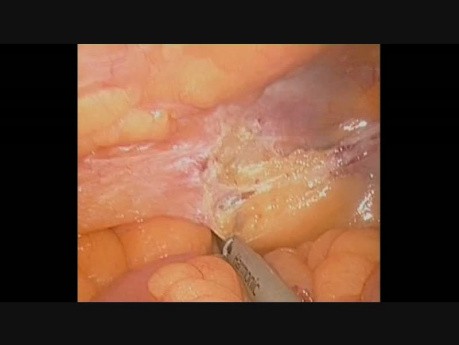 Primary SASI to Treat Type 2 Diabetic Patients
