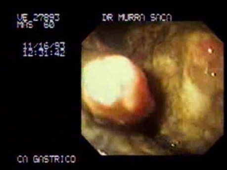 Cancer of Stomach