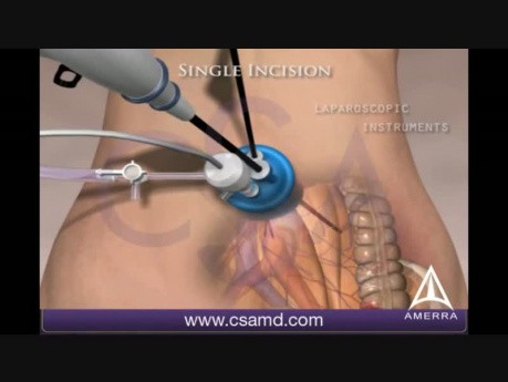 Single Incision Laparoscopic Colectomy utilizing SILS port - 3D Medical Animation