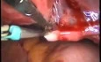 Laparoscopic Péritubal And Ovarian Adhésyolysis