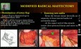 Modified Radical Mastectomy - Theoretical Aspects