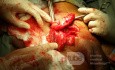 Amyand Hernia