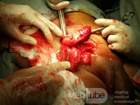 Amyand Hernia