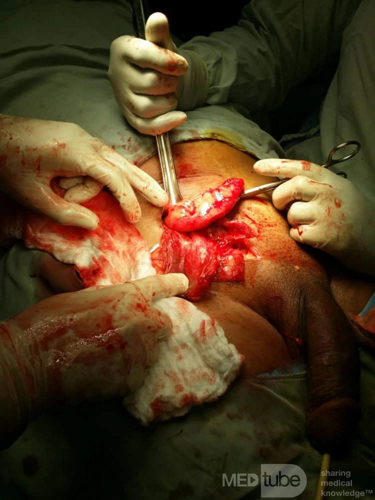 Amyand Hernia