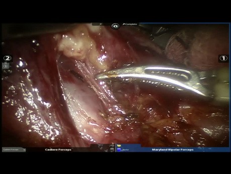 Robotic Anatomic Segmentectomy