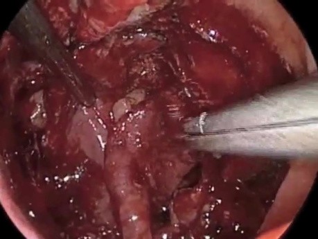 Endoscopic Reconstruction of Skull Base by the Use of Nasoseptal Flap