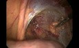Laparoscopic right inguinal hernia repair