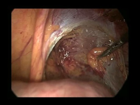 Laparoscopic right inguinal hernia repair