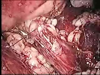 Laparoscopic Ureterolithotomy Retroperitoneal after failed ESWL
