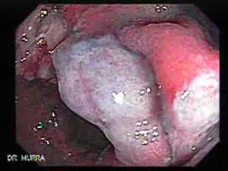 Cap polyposis that resemble a adenocarcinoma of the rectum (4 of 7)