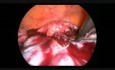 Laparoscopy for Bilateral Ovarian Metastatic Masses